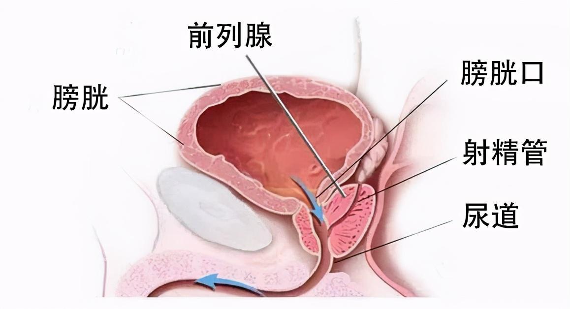 前列腺炎能好嗎？全面解析前列腺炎的治療與康復(fù)，全面解析前列腺炎治療與康復(fù)，能否痊愈？