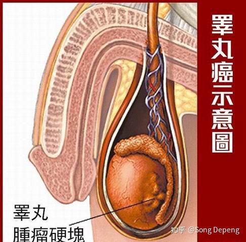 睪丸癌的成因探究，睪丸癌成因深度探究