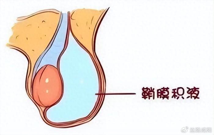 后悔做鞘膜積液手術(shù)，后悔進(jìn)行鞘膜積液手術(shù)的原因分析